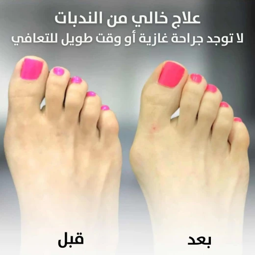 جبيرة تقويم الإبهام لتصحيح الورم, دعامة تقويمية غير جراحية لتخفيف الألم ومحاذاة إصبع القدم، قابلة للتعديل ومريحة للاستخدام اليومي - Image 2