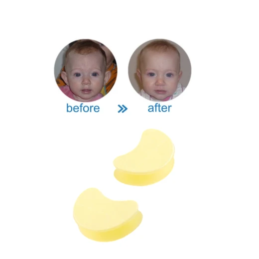 Baby Ear Corrector Plaster - Chromosome - Image 2
