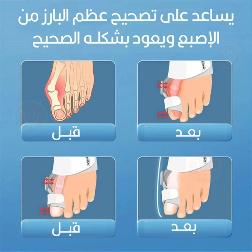 جهاز تصحيح إبهام القدم مصحح الورم لمدة 30 يوم فاصل أصابع القدم لتقويم إبهام القدم وتخفيف آلام الورم - Image 2